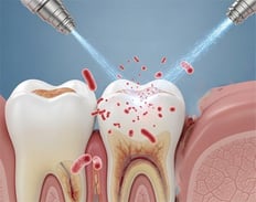 Soigner infection bouche jet avec un jet dentaire ozone Aquolab hygiene-precision.com