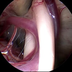 Endoscopic view - Compressing blood vessel