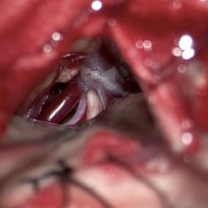 Microscopic view - Compressing blood vessel