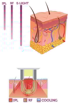 laser-for-blonde-and-red-hair