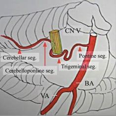 Blood vessel compressing Trigeminal nerve