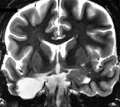 Ressonância após cirurgia no cérebro com remoção da amígdala e hipocampo. Ela ficou sem epilepsia.