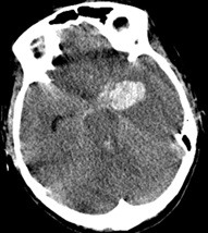Tomografia mostrando hematoma intracerebral no lobo temporal esquerdo.