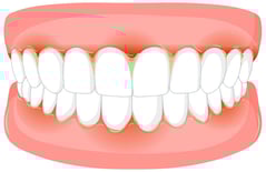 gingivite soins jet dentaire ozone aquolab hygiene-precision