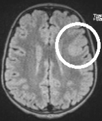 Ressonância de menino de 7 anos com epilepsia desde os 3 anos.