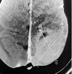 CT SCAN OF 1997