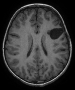 Ressonância após a cirurgia do cérebro com remoção total da displasia. Ele se curou da epilepsia.