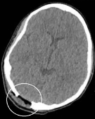 Tomografia após a retirada do tumor ósseo. Histiocitose de células de Langerhans.