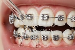 nettoyer appareil orthodontique hygiene-precision.com