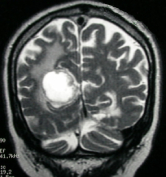 Ressonância de paciente com câncer de pulmão e tumor occipital direito antes da cirurgia no cérebro.