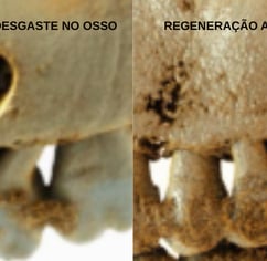 imagem do osso regenerado após o tratamento de canal