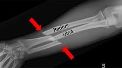 Forearm Fracture- Dr. T. Aravindh MBBS, MS( ORTHO)