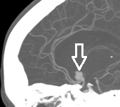 Angiotomografia perfil mostrando o aneurisma cerebral (seta).