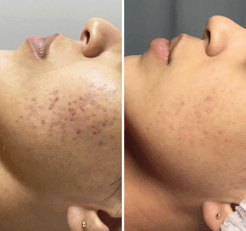 Botox-preenchimento-labial-bio-estimulador-de-colageno-em-pitanga-região-dra.-josiane