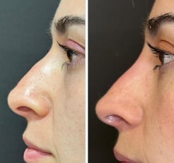 Botox-preenchimento-labial-bio-estimulador-de-colageno-em-pitanga-região-dra.-josiane