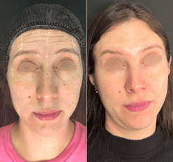Botox-preenchimento-labial-bio-estimulador-de-colageno-em-pitanga-região-dra.-josiane