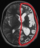 Ressonância de menina de 8 anos com epilepsia desde os 3. Atrofia do hemisfério cerebral esquerdo.