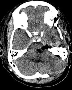 Tomografia após a cirurgia no cérebro e remoção do cavernoma.