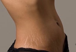 Estrías blancas en zona lateral del abdomen