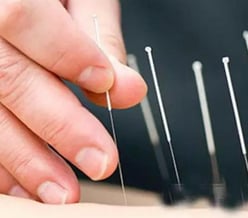 Acupuncture