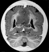 Ressonância de menino de 2 anos com grave malformação cerebral bilateral e epilepsia grave.