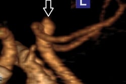 Angiotomografia 3D projeção perfil