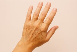 Mano con manchas representando hiperpigmentación