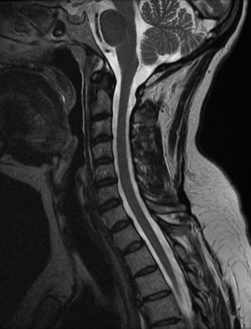 Spine MRI