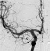 Angiografia digital projeção frontal após a cirurgia no cérebro e clipagem do aneurisma cerebral.