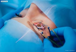 Refractive Surgery