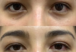 Orbit & Oculoplasty