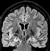Ressonância de moça de 18 anos com epilepsia desde 12 anos. O círculo indica a esclerose hipocampal.
