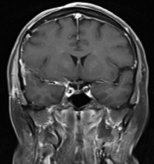 Resoonância magnética após a cirurgia mostrando a retirada total do meningeoma.