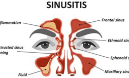 sinusitis