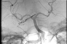 Angiografia digital projeção frontal após a cirurgia no cérebro e clipagem do aneurisma cerebral.
