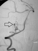 Angiografia digital projeção oblíqua. A seta indica o aneurisma cerebral.