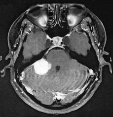 Ressonância de paciente com meningeoma petroso direito antes da cirurgia.