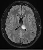 Ressonância de paciente com cefaleia e tumor no ventrículo esquerdo antes da cirurgia no cérebro.a.