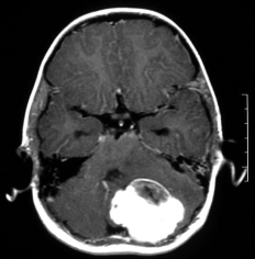 Ressonância de menino com cefaleia e volumoso tumor no cerebelo antes da cirurgia.