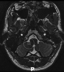 Ressonância magnética de um paciente com tumor no cerebelo antes da cirurgia.