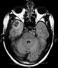 Ressonância de paciente epiléptica com tumor temporal direito antes da cirurgia no cérebro.
