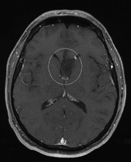 Ressonância de um paciente epiléptico com tumor fronto-basal antes da cirurgia no cérebro.