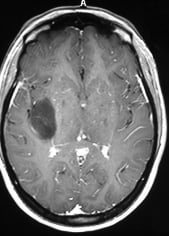 Ressonância de paciente epiléptica com tumor na ínsula direita antes da cirurgia no cérebro.