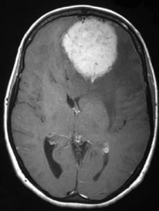 Ressonância de paciente com cefaleia e volumoso tumor frontal esquerdo antes da cirurgia no cérebro.