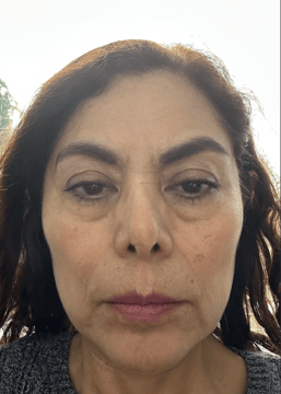 Face Yoga Result - Before