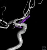 Reconstrução 3D da angiotomografia após a cirurgia no cérebro e clipagem do aneurisma cerebral.