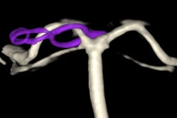 Angiografia digital 3D projeção frontal após a cirurgia no cérebro e clipagem do aneurisma cerebral.
