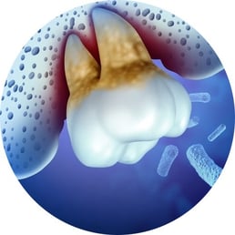 parodontite avant et après traitementsoins jet dentaire ozone hygiene-precision.com