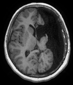 Ressonância após a cirurgia no cérebro com a hemisferotomia. Ela ficou livre da epilepsia.