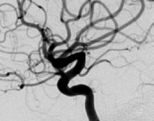 Angiografia digital projeção perfil após a cirurgia no cérebro e clipagem do aneurisma cerebral.